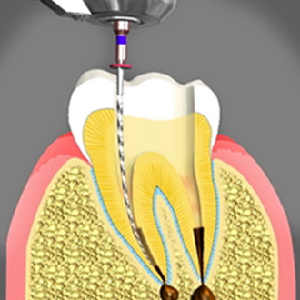 root canal treatment Chino CA