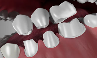 Dental-Bridges