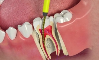 What Is An Endodontist