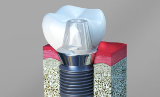 dental-implants