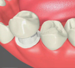 Dental Crowns Chino California