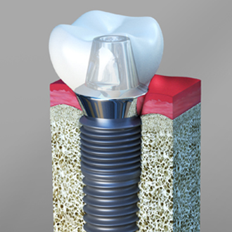dental implants Chino CA