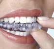 Invisalign Chino California