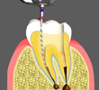 Root Canal Treatments Chino California